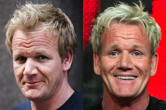 Gordon Ramsey trapianto capelli