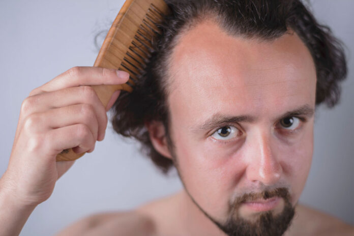 calvizie psicologia calvizie psicologia