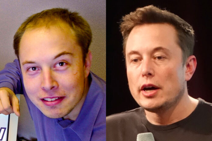 elon musk trapianto capelli