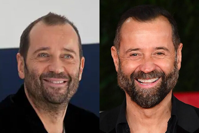 fabio volo trapianto capelli