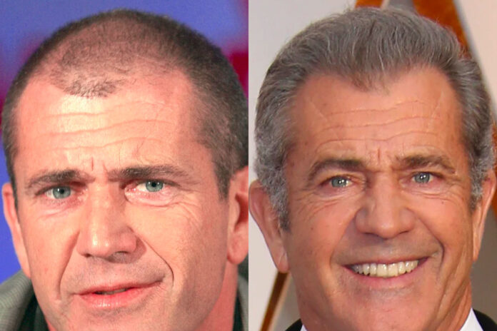 mel gibson trapianto capelli
