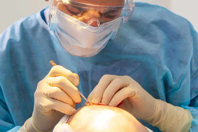 pro e contro trapianto di capelli pro e contro trapianto di capelli