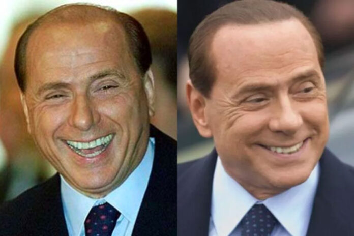 silvio berlusconi trapianto capelli