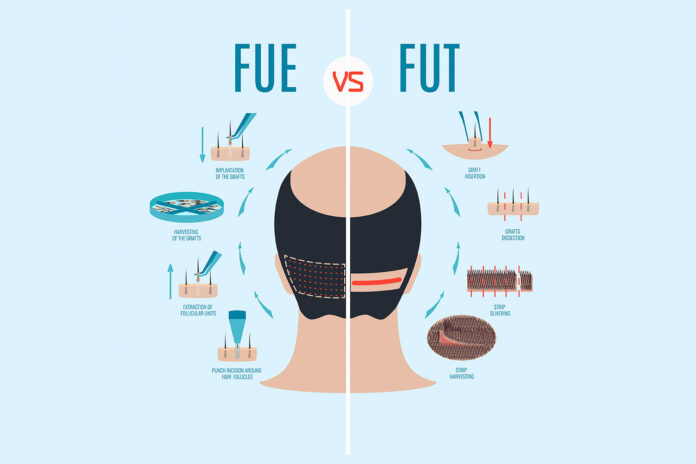 tecniche trapianto capelli