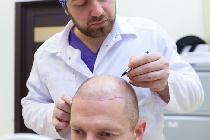 tempo ricrescita capelli dopo trapianto