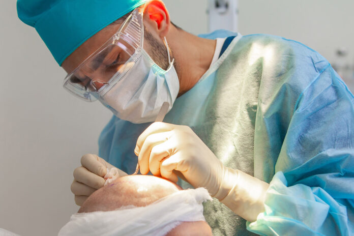 trapianto di capelli