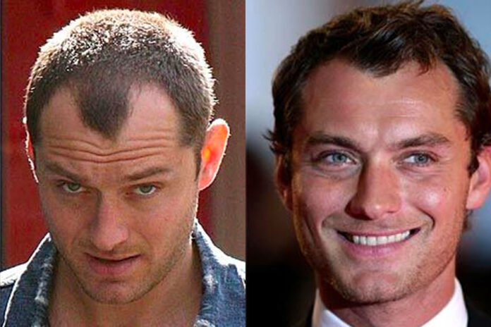 jude law trapianto capelli