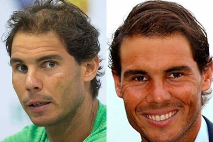 rafael nadal trapianto capelli